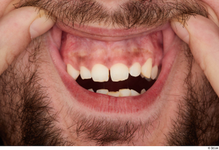 Hamza teeth 0002.jpg
